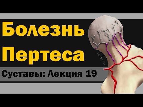 Видео: Болезнь Пертеса [S05E19]