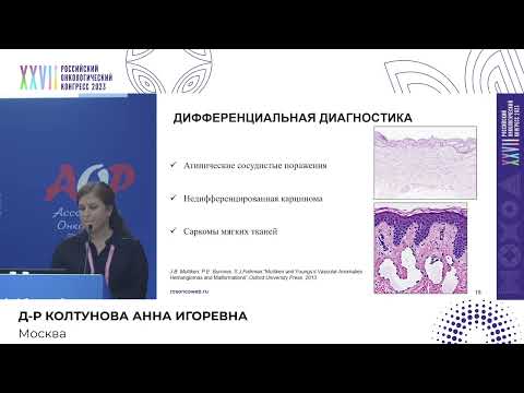 Видео: Радиоиндуцированная ангиосаркома молочной железы