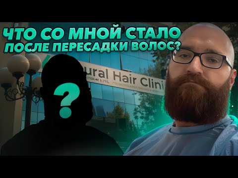 Видео: Результат пересадки волос! Что со мной стало после пересадки волос в Узбекистане?