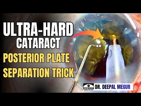 Видео: Задняя кожистая пластинка при плотной катаракте: трюк: «Поднимите основание вверх и проведите фак...