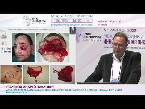 Видео: Реконструкция верхней челюсти. Протезирование или микрохирургическая реконструкция_Поляков А.П.