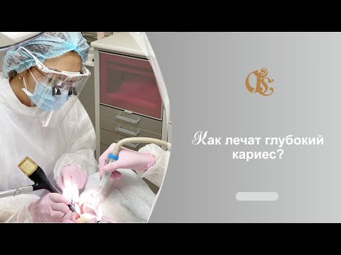 Видео: Как лечат глубокий кариес в Гильдии стоматологов? Лечение глубокого кариеса в Санкт-Петербурге