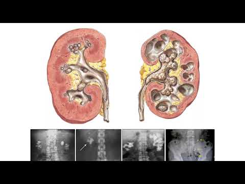 Видео: Ультразвуковая диагностика (УЗИ). Доктор Иогансен. Выпуск 82. Мочекаменная болезнь Часть 1.