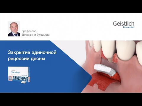 Видео: Закрытие одиночной рецессии десны. Fibro-Gide / проф. Джованни Зуккелли