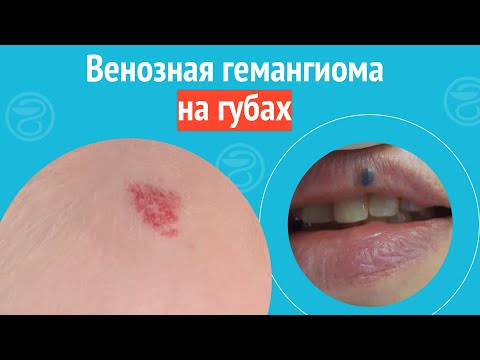 Видео: 🫦 Венозная гемангиома на губах. Клинический случай №1382