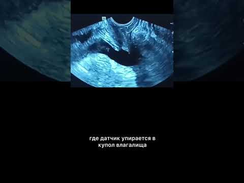 Видео: #узи #гистерэктомия