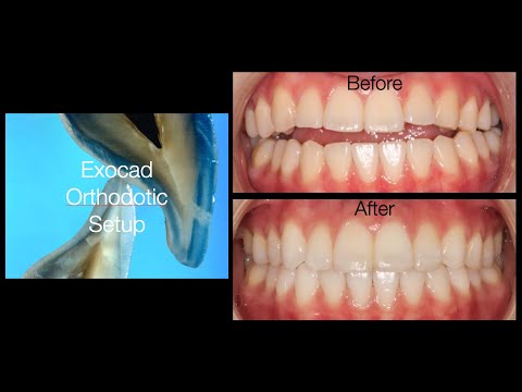 Видео: Ортодонтическая установка ExoCad — нехирургическое лечение открытого прикуса