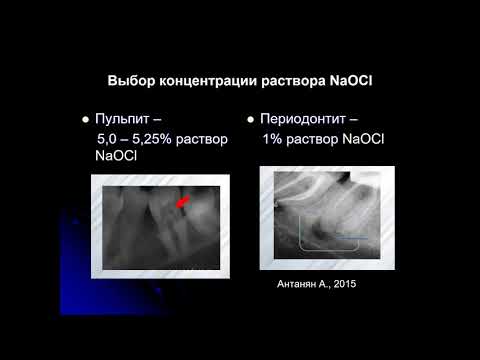 Видео: Эндодонтия 3.Лечение апикальных периодонтитов