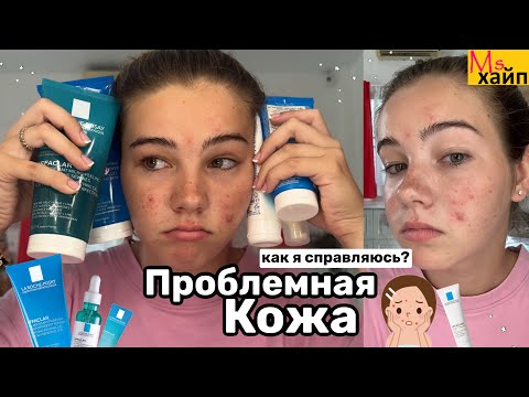 Видео: МОЯ ПРОБЛЕМНАЯ КОЖА || снова акне😭 как я справляюсь?