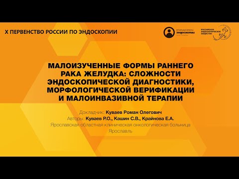 Видео: МАЛОИЗУЧЕННЫЕ ФОРМЫ РАННЕГО РАКА ЖЕЛУДКА
