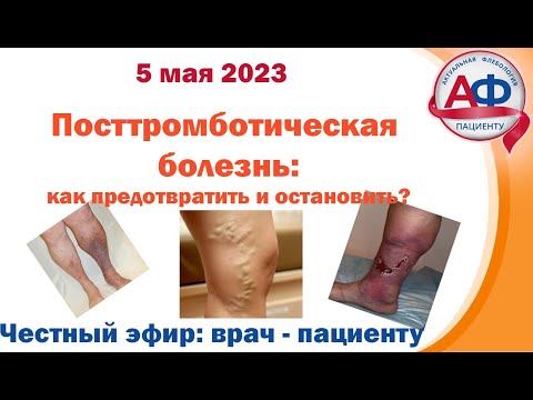 Видео: Посттромботическая болезнь  Как предотвратить и остановить