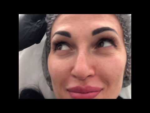 Видео: Коррекция носа филлерами (контурная пластика)