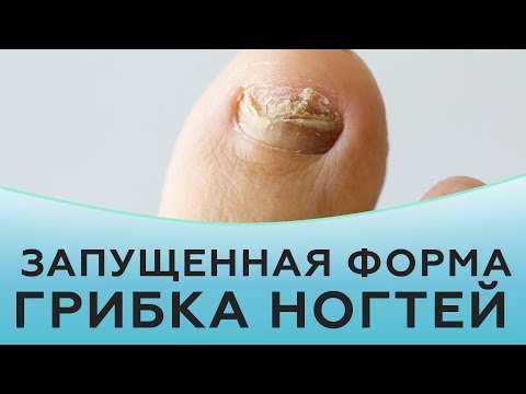 Видео: Грибок ногтей. Лечение запущенной формы грибка ногтей