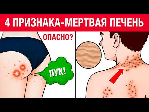 Видео: 6 главных признаков УМИРАЮЩЕЙ ПЕЧЕНИ! Как быстро проверить здоровье печени?