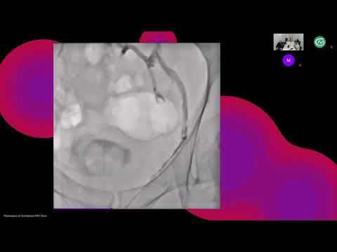 Видео: Прямая перкутанная рентгенэндоваскулярная окклюзия вен простатического сплетения.