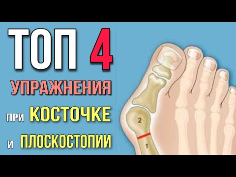 Видео: Топ-4 УПРАЖНЕНИЯ от КОСТОЧКИ на большом пальце ноги (Hallux Valgus) или ПЛОСКОСТОПИЯ