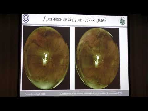 Видео: Широкопольная визуализация и лазерная коагуляция на крайней периферии на установке Navilas