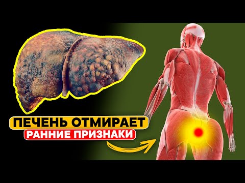 Видео: 14 ранних Признаков того, что ваша ПЕЧЕНЬ ОТМИРАЕТ. 90% с проблемами печени даже не знают об этом