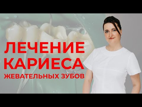 Видео: Как вылечить жевательные зубы от кариеса? Лечение кариеса под старыми пломбами