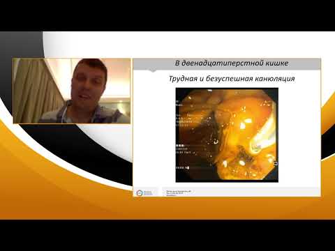 Видео: 2. Недолужко И.Ю. Кулезнёва Ю.В. Мелехина О.В. Методика рандеву в панкреато-билиарной эндоскопии.