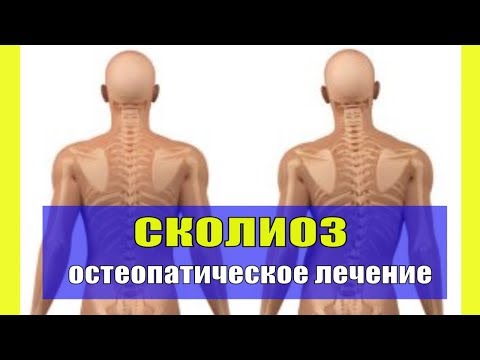 Видео: Как лечить сколиоз Остеопатический подход