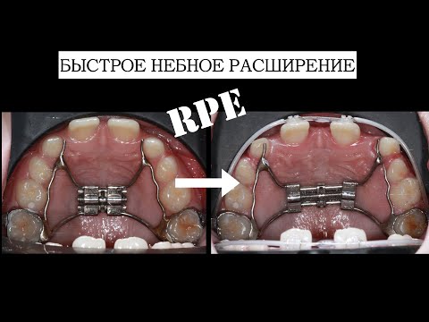 Видео: Rapid palatal expansion:Быстрое небное расширение/ RPE (English subtitles)