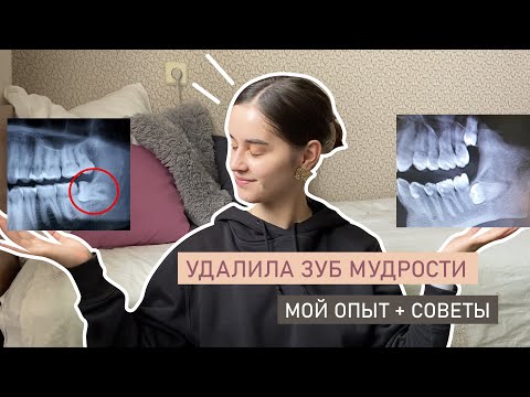 Видео: УДАЛИЛА ЗУБ МУДРОСТИ | КАК ПРОШЛО И РЕКОМЕНДАЦИИ