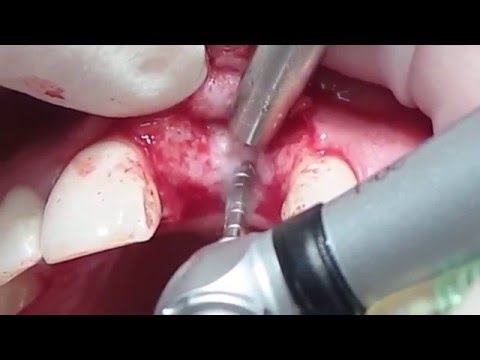 Видео: 17 января 2014. Мария Александровна Носова. Эпизод 1. Имплантация Implay 4,2*13.