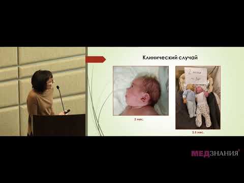 Видео: Синдром Корнелии де Ланге (Синдром Брахмана- Ланге. Амстердамская карликовость)