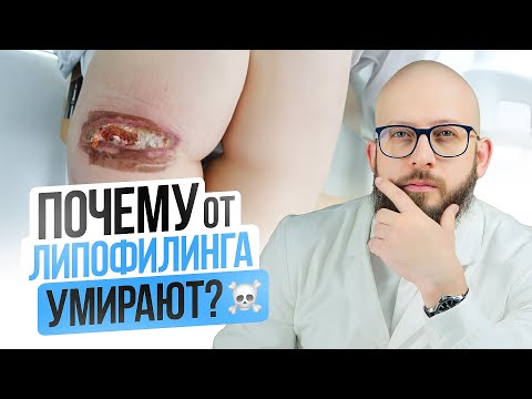 Видео: Смертельный Липофилинг Ягодиц. Почему от Липофилинга умирали? Безопасен ли липофилинг сейчас?