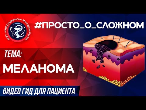 Видео: #ПРОСТО_о_СЛОЖНОМ  - МЕЛАНОМА