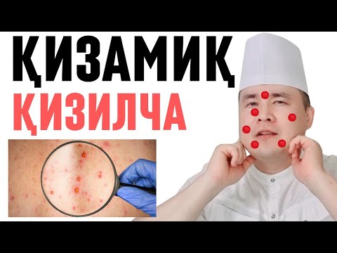 Видео: ҚИЗАМИҚ КОРЬ ХАҚИДА БАФУРЖА, ҚИЗИЛЧАДАН ФАРҚИ, БЕЛГИЛАРИ, АСОРАТИ ВА ДАВО ЧОРАЛАРИ ИСЧАНОВ ДОКТОР