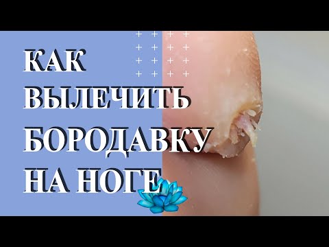 Видео: Бородавка на пальце ноги. Вирус папилломы человека лечение.