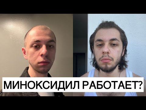 Видео: РАБОТАЕТ ЛИ МИНОКСИДИЛ? ДНЕВНИК