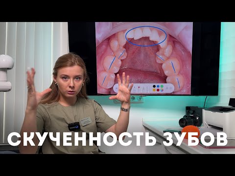 Видео: Скученность зубов — что делать, когда зубам нет места в зубном ряду?