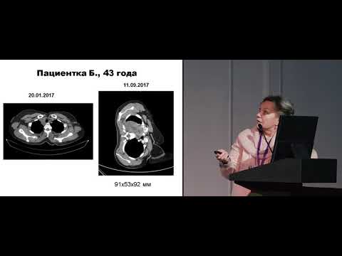Видео: Случай лечения диссеминированной меланомы с мутацией в гене BRAF