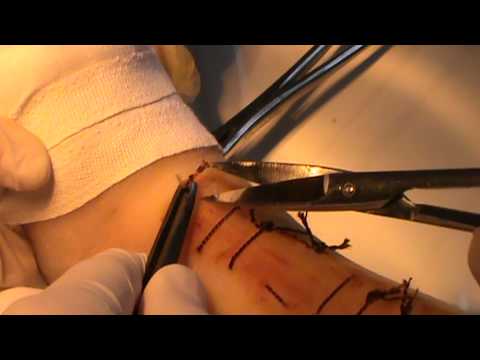 Видео: Снятие хирургических швов. Docent A.D. Stepanov, ПДАТУ