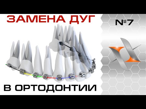Видео: Замена дуг: практика. (ортодонтия, мини-лекция)