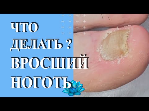 Видео: Вросший ноготь на ноге. Что делать?