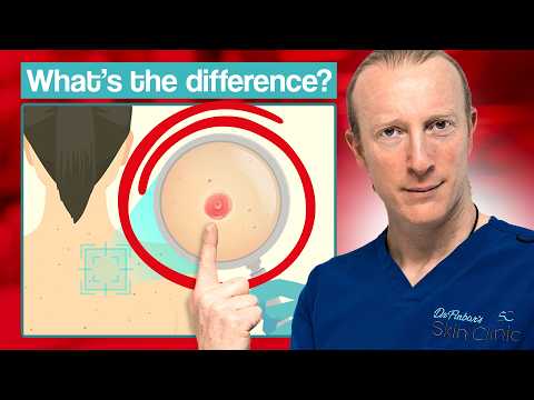 Видео: Доброкачественное поражение кожи или рак кожи: что делать?