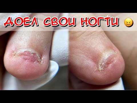 Видео: Съел все ногти / грызет ногти что делать / как отучить грызть ногти / погрыз все ногти / Сгрыз ногти