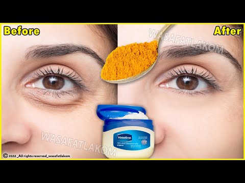 Видео: за 3 дня Полностью удалить мешки под глазами | Удаление темных кругов, морщин, опухших глаз