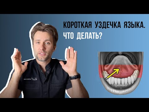 Видео: Когда нужно подрезать короткую уздечку языка👅