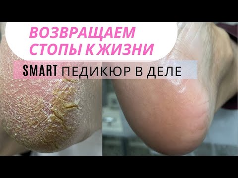 Видео: Возвращаем стопы к жизни!Выполняем Smart педикюр от и до! #педикюр #педикюрдисками