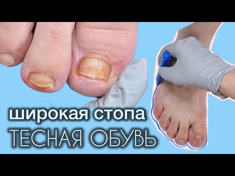 Видео: МОЗОЛИ, вросшие ногти, толстые ногти. Широкая стопа