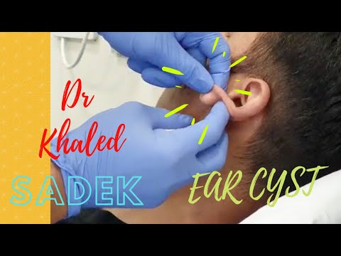 Видео: Огромная киста уха, которой 15 лет. Доктор Халед Садек. Lipomacyst.com