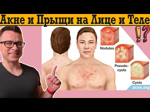Видео: БОЛЬШЕ НИКАКИХ ПРЫЩЕЙ И АКНЕ!
