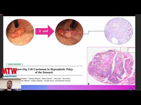Видео: Почему не нужно удалять гиперпластические полипы желудка