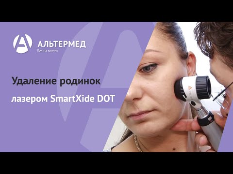 Видео: Альтермед. Удаление родинок лазером SmartXide DOT