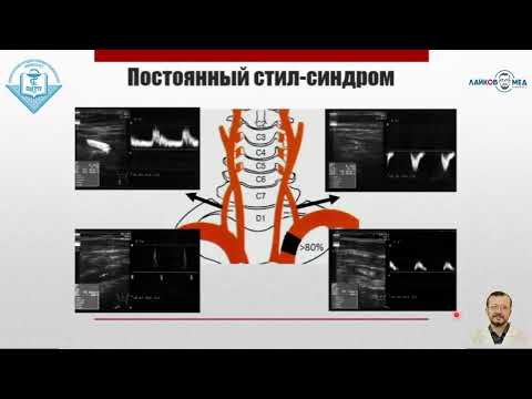 Видео: УЗИ брахиоцефальных сосудов, Часть 2 / Лайков Алексей Владимирович - врач УЗИ, к.м.н.